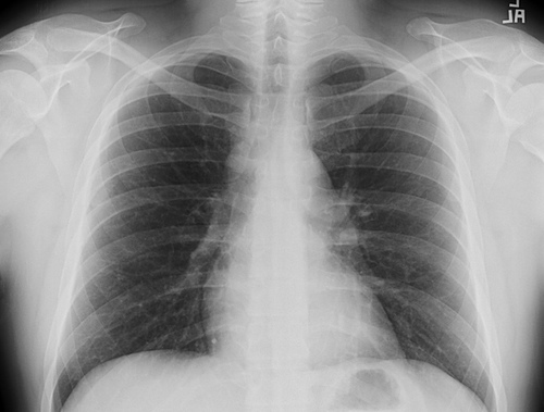 Chest x-ray